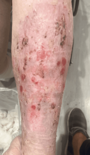 NextGen Wound Care NextGen Wound Care