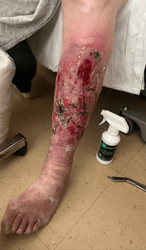 NextGen Wound Care NextGen Wound Care