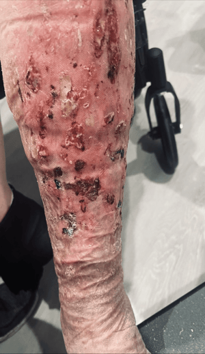 NextGen Wound Care NextGen Wound Care